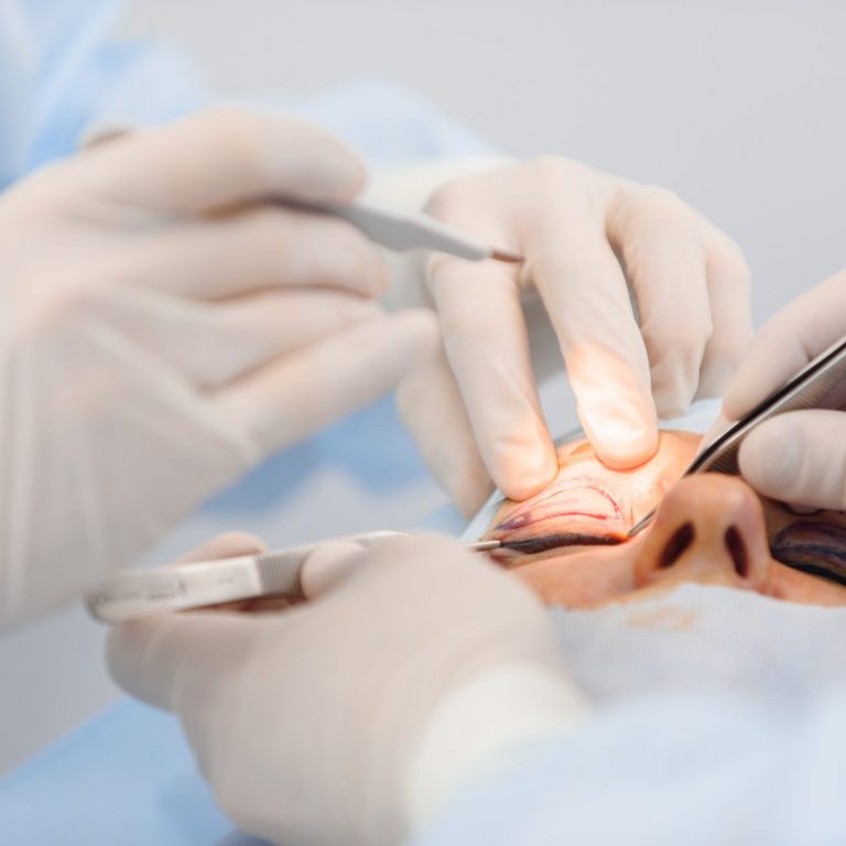 Entfernung von Tränensäcken durch feinchirurgische Unterlidkorrektur in der MKG-Praxis Trier.